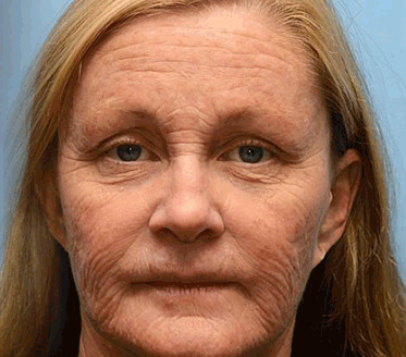 👨‍⚕️ Tillverkad och skickad från Sverige- Pureluxo® Botox Bee Venom Anti-Rynk Kräm – SISTA DAGEN 80% RABATT